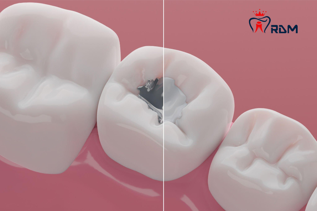Amalgam VS Composite Fillings Choosing The Right Dental Restoration